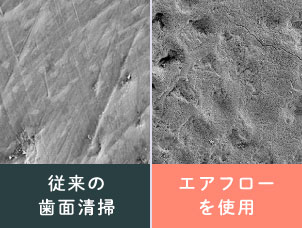 従来の歯面清掃／エアフローを使用
